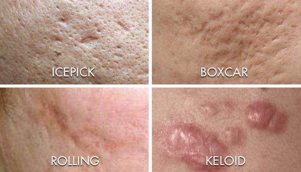 acne scar removal singapore