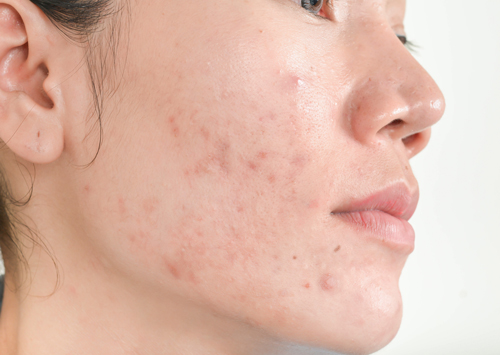 acne skin