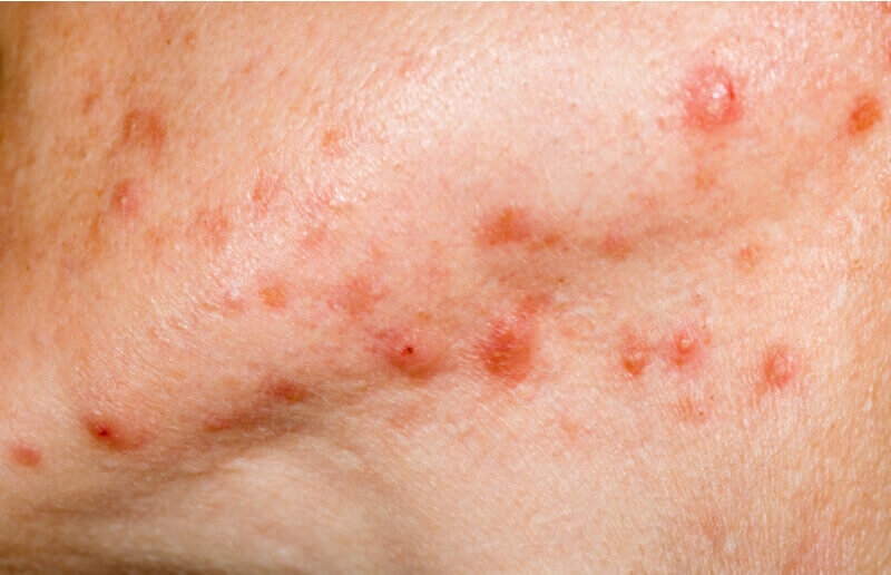 cystic vs hormonal acne