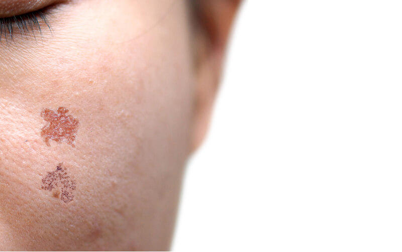 which acne scar for fractional laser