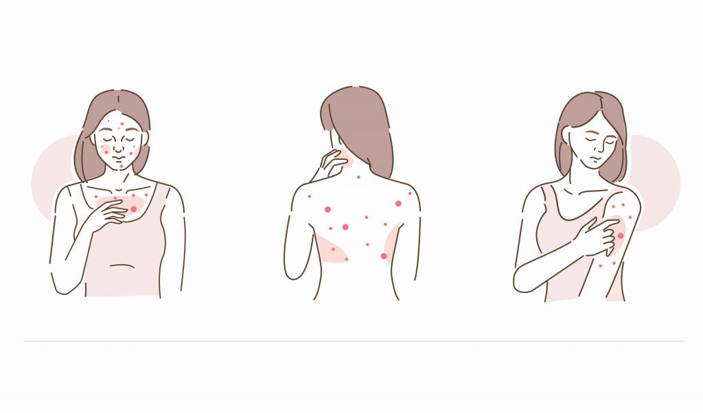 common areas of acne face body neck